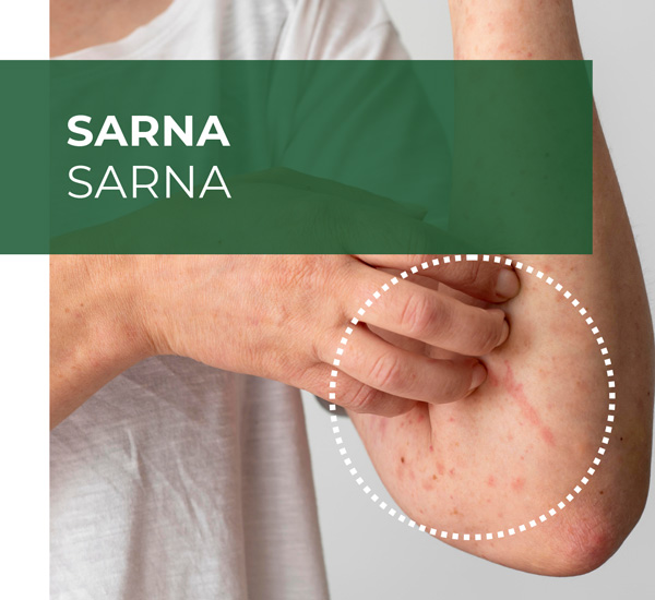 sarna